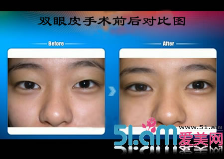韩式三点双眼皮手术图片