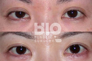 韩国BIO整形外科眼修复整形案例