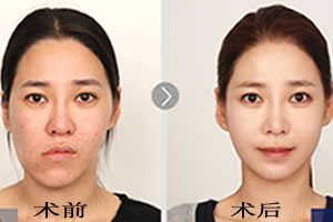 韩国菲斯莱茵双颚+面部轮廓手术案例.jpg