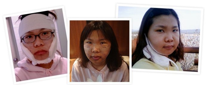 去韩国改脸型整容经历分享