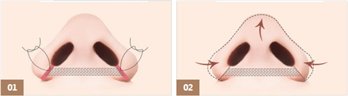 鼻子缩小手术缝合过程示意图