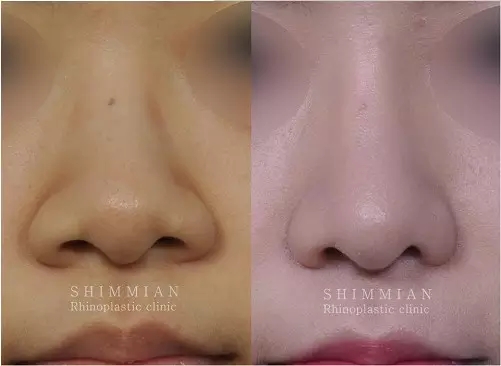 韩国心美眼整形外科鼻部手术案例