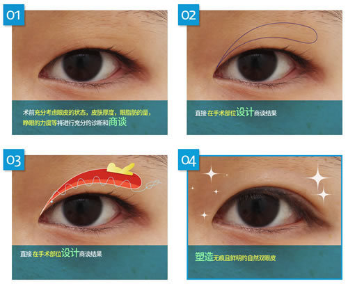 韩国芙莱思医院埋线双眼皮手术手术方法