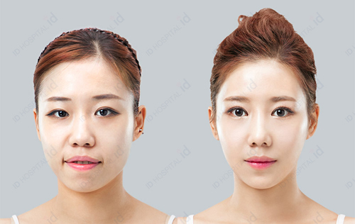 韩国ID整形外科隆鼻案例