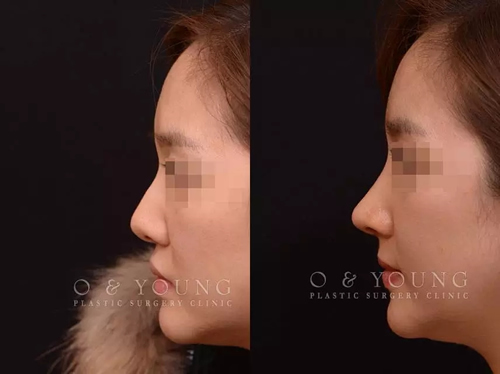 O&YOUNG整形外科隆鼻案例