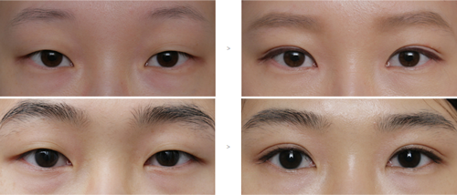 韩国麦恩整形外科双眼皮案例对比