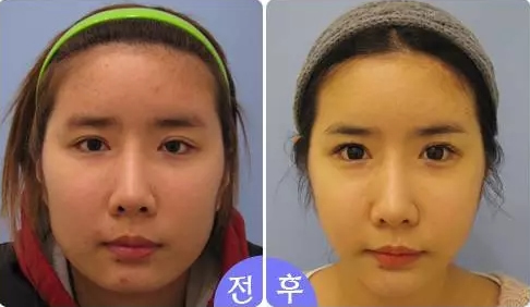 韩国美自人整形外科双眼皮整形案例