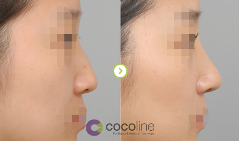 韩国cocoline整形外科医院无假体隆鼻对比图