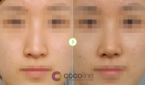 韩国cocoline整形外科医院隆鼻修复（歪鼻）矫正对比图