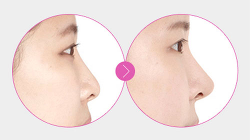 韩国TL整形外科鼻修复手术前后对比案例