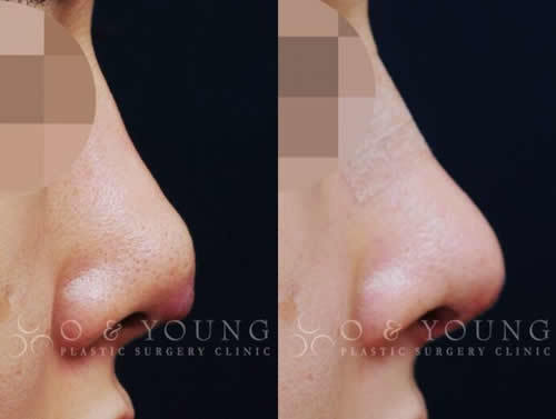 韩国O&Young整形外科鼻修复案例