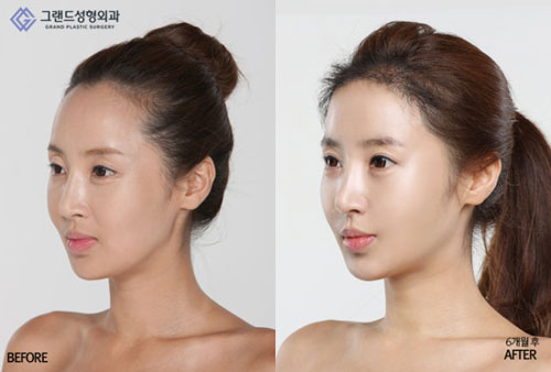 韩国高兰得整形外科心形脸对比案例
