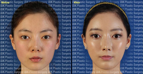 韩国BK整形外科脂肪填充对比案例