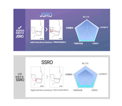 JSRO双鄂手术与SSRO双鄂手术对比.jpg