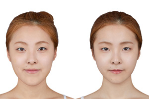 韩国双颚长脸整形对比.jpg