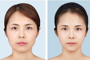 韩国原辰下颌角整形案例对比图.jpg