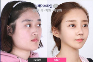 韩国菲斯莱茵下颌角缩小术对比图.jpg