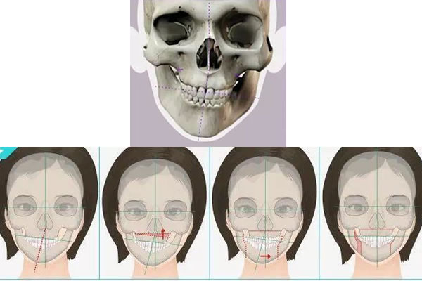 面部骨骼不对称CT图.jpg