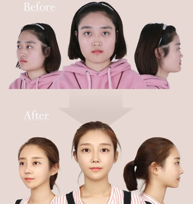 韩国菲斯莱茵Faceline整形外科面部轮廓整形案例