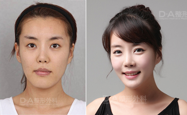 韩国DA整形外科面部轮廓整形对比案例