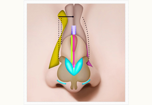 缩减鼻骨宽度的多种截骨方向与手术方法