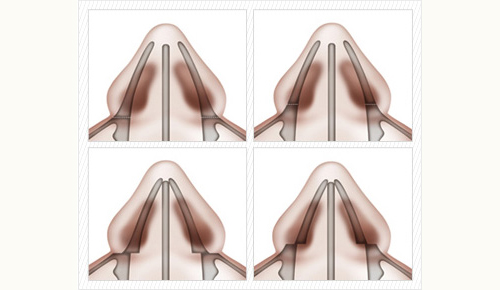 缩减鼻骨宽度的多种截骨方向与手术方法