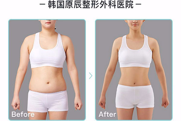 韩国原辰整形医院腰部吸脂整形案例