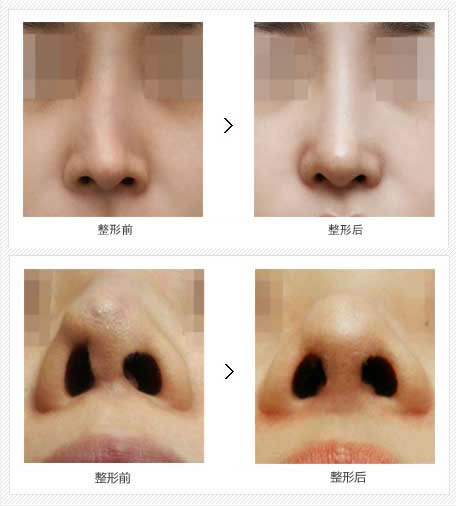 假体隆鼻术后修复对比案例.jpg