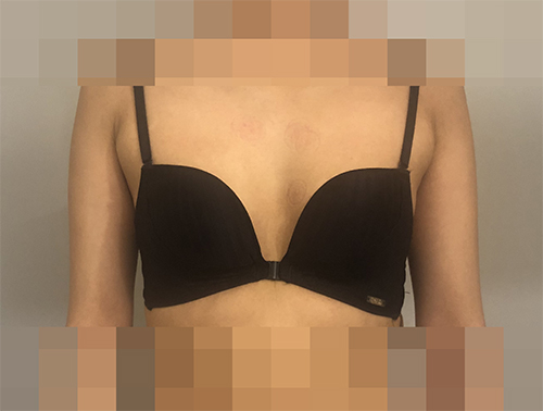 韩国普罗菲耳profile整形医院假体隆胸术前照片