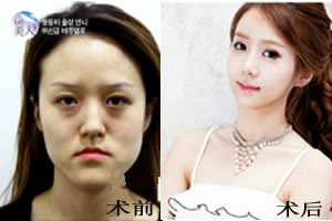 韩国菲斯莱茵双颚手术+面部轮廓手术案例.jpg