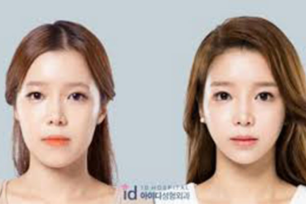 韩国ID整形医院面部轮廓整形案例