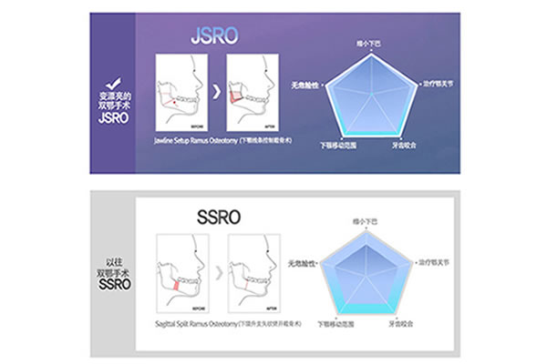 82整形JSRO与SSRO对比.jpg