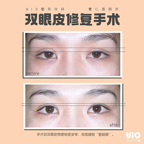 韩国BIO整形外科双眼皮修复手术案例