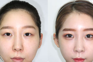 韩国郑成模院长面部轮廓整形案例
