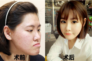 韩国菲斯莱茵JSRO双颚手术术前术后对比照.jpg