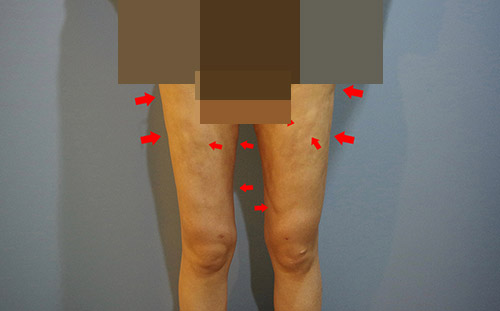 韩国丽迪安整形医院腿部吸脂修复术前照片