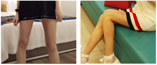 韩国丽迪安整形医院腿部吸脂修复术后效果