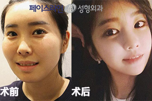 韩国菲斯莱茵双颚+面部轮廓手术案例前后对比图.jpg