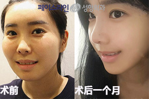 韩国菲斯莱茵双颚手术+面部轮廓手术后一个月.jpg