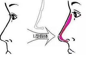 鼻子假体放置示例图