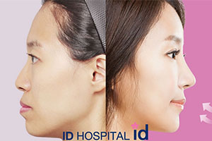 韩国ID整形外科医院双鄂手术案例