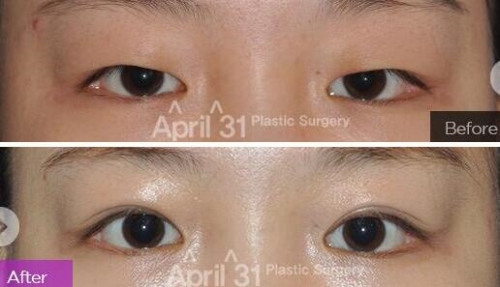 韩国医院双眼皮手术案例