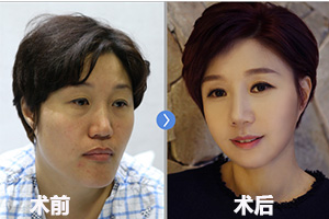 韩国菲斯莱茵童颜轮廓手术案例对比图.jpg