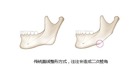 传统下颌角手术