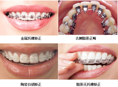 牙齿矫正的各种方法