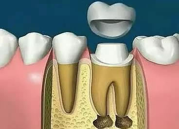 补牙的手术方案.jpg