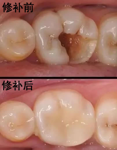 牙齿小黑点造成龋齿修复前后对比图.jpg