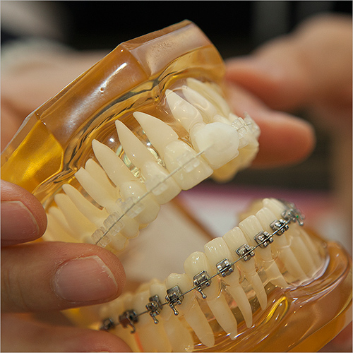 牙齿矫正的模型