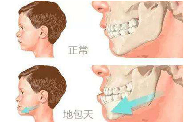 正常牙齿与地包天牙齿对比