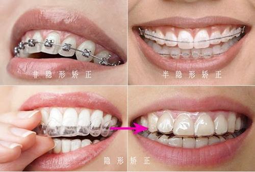 牙齿矫正方法不同对比